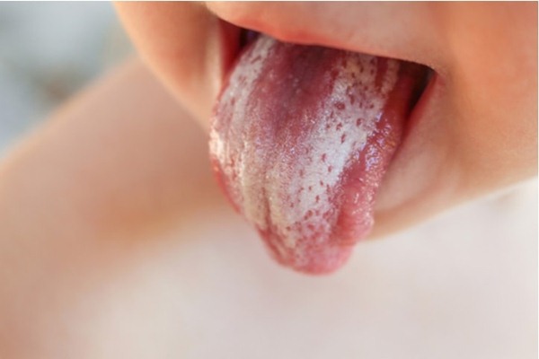 Trẻ sơ sinh và trẻ nhỏ dễ mắc bệnh nấm lưỡi nếu không vệ sinh khoang miệng thường xuyên. Ảnh minh họa